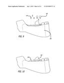 DEVICES AND METHODS FOR ENHANCING BONE GROWTH diagram and image