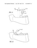 DEVICES AND METHODS FOR ENHANCING BONE GROWTH diagram and image