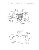 DEVICES AND METHODS FOR ENHANCING BONE GROWTH diagram and image