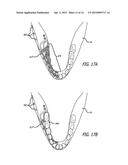 DEVICES AND METHODS FOR ENHANCING BONE GROWTH diagram and image