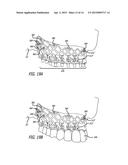 DEVICES AND METHODS FOR ENHANCING BONE GROWTH diagram and image