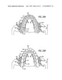 DEVICES AND METHODS FOR ENHANCING BONE GROWTH diagram and image