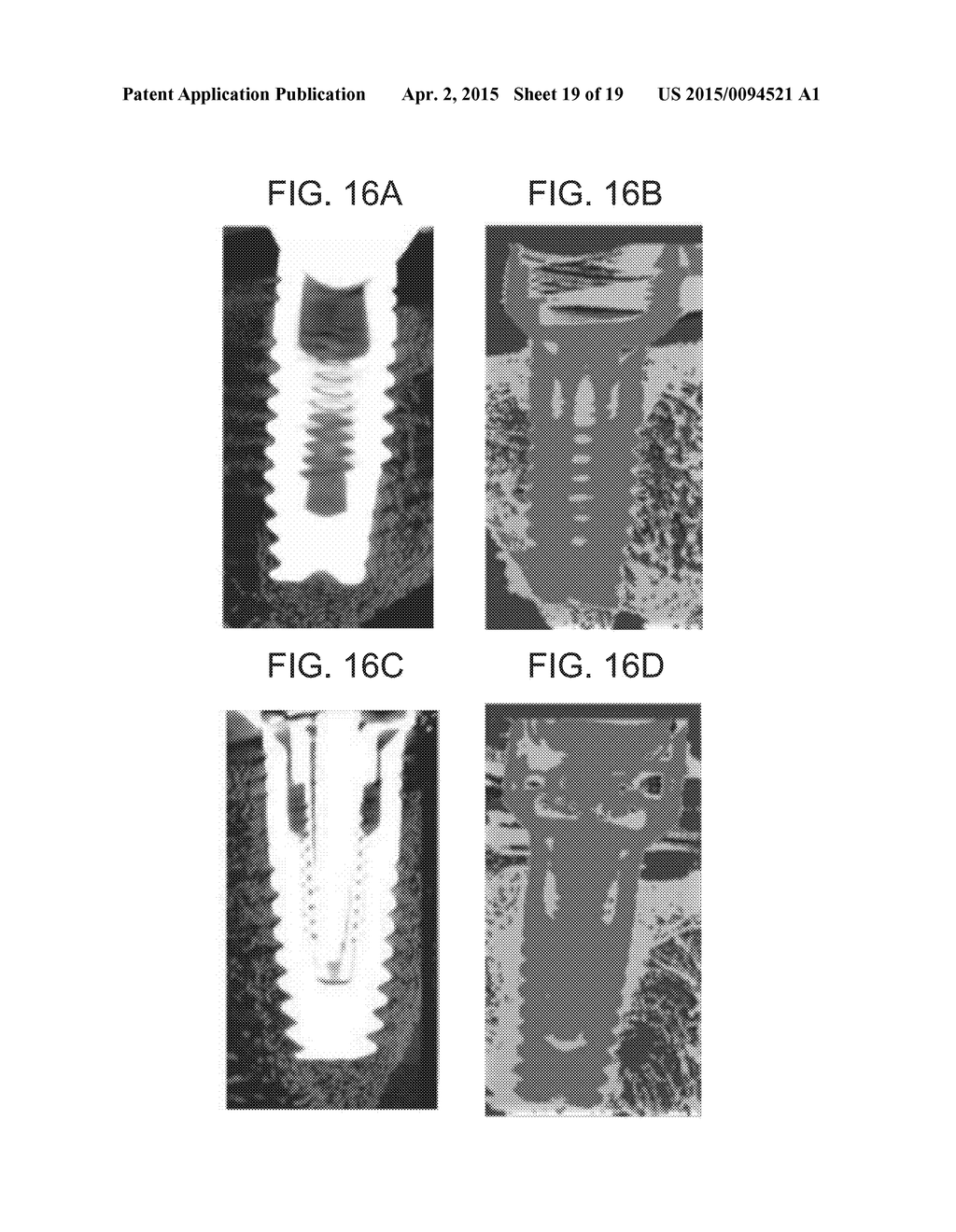 BONE ENHANCEMENT DEVICE AND METHOD - diagram, schematic, and image 20