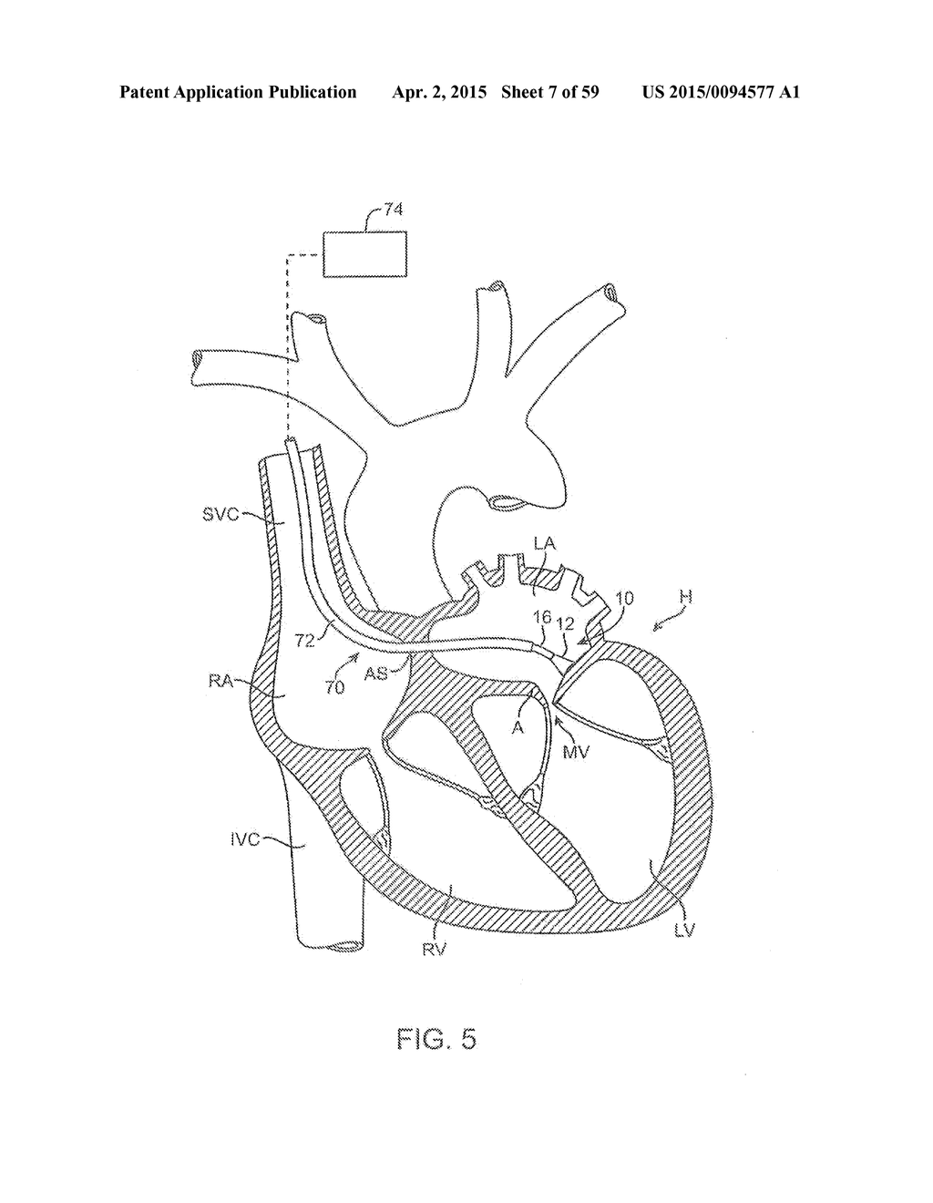 Electrophysiology Mapping And Visualization System - diagram, schematic, and image 08