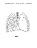 PREFERENTIAL VOLUME REDUCTION OF DISEASED SEGMENTS OF A HETEROGENEOUS LOBE diagram and image