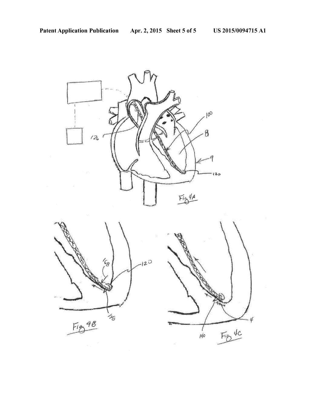 METHODS AND DEVICES FOR DIASTOLIC ASSIST - diagram, schematic, and image 06