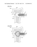 BONE TREATMENT SYSTEM diagram and image