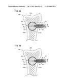 BONE TREATMENT SYSTEM diagram and image