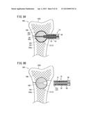 BONE TREATMENT SYSTEM diagram and image