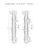 Rotational Atherectomy Device with Fluid Inflatable Support Elements and     Distal Protection Capability diagram and image