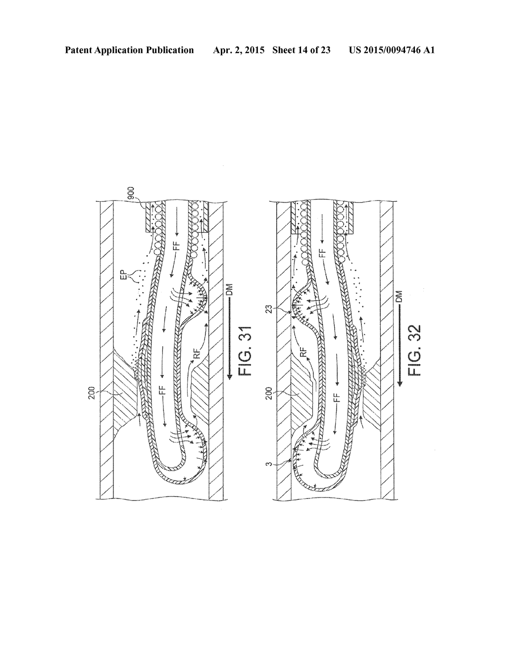 Rotational Atherectomy Device with Fluid Inflatable Support Elements and     Distal Protection Capability - diagram, schematic, and image 15