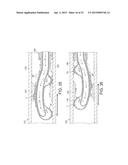 Rotational Atherectomy Device with Fluid Inflatable Support Elements and     Distal Protection Capability diagram and image