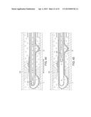 Rotational Atherectomy Device with Fluid Inflatable Support Elements and     Distal Protection Capability diagram and image