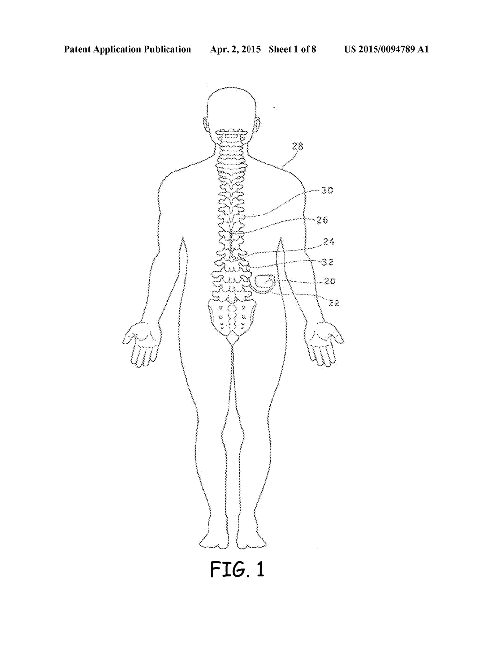 IMPLANTABLE DEVICE WITH CHASSIS ELEMENT - diagram, schematic, and image 02