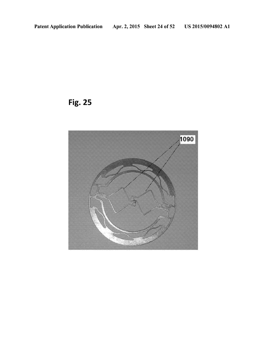 SINGLE-RING CARDIAC VALVE SUPPORT - diagram, schematic, and image 25