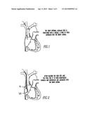 Percutaneous Right Ventricular Assist Apparatus and Method diagram and image