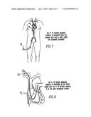 Percutaneous Right Ventricular Assist Apparatus and Method diagram and image