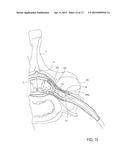 SHEATH SUPPORT DEVICES, SYSTEMS AND METHODS diagram and image