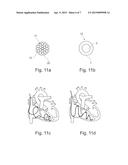 MICROLEAD FOR DETECTION/STIMULATION, IMPLANTABLE IN VENOUS, ARTERIAL OR     LYMPHATIC NETWORKS diagram and image