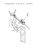 SCANNING CANNULA diagram and image