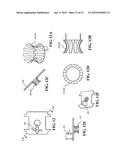 SCANNING CANNULA diagram and image