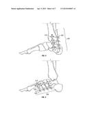 FOOT, ANKLE AND LOWER EXTREMITY COMPRESSION AND FIXATION SYSTEM AND     RELATED USES diagram and image