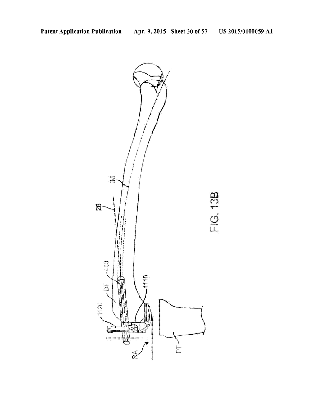 KNEE BALANCING FOR REVISION PROCEDURES - diagram, schematic, and image 31