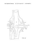 KNEE BALANCING FOR REVISION PROCEDURES diagram and image