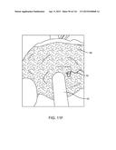 METHOD FOR PROVIDING SURGICAL ACCESS diagram and image