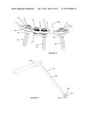 Polyaxial Plate Rod System and Surgical Procedure diagram and image