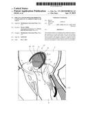 IMPLANT AND METHOD FOR IMPROVING COAPTATION OF AN ATRIOVENTRICULAR VALVE diagram and image