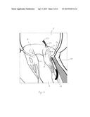 IMPLANT AND METHOD FOR IMPROVING COAPTATION OF AN ATRIOVENTRICULAR VALVE diagram and image