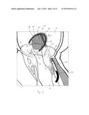 IMPLANT AND METHOD FOR IMPROVING COAPTATION OF AN ATRIOVENTRICULAR VALVE diagram and image