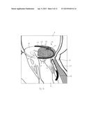 IMPLANT AND METHOD FOR IMPROVING COAPTATION OF AN ATRIOVENTRICULAR VALVE diagram and image