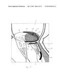 IMPLANT AND METHOD FOR IMPROVING COAPTATION OF AN ATRIOVENTRICULAR VALVE diagram and image