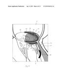 IMPLANT AND METHOD FOR IMPROVING COAPTATION OF AN ATRIOVENTRICULAR VALVE diagram and image