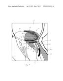 IMPLANT AND METHOD FOR IMPROVING COAPTATION OF AN ATRIOVENTRICULAR VALVE diagram and image