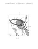 IMPLANT AND METHOD FOR IMPROVING COAPTATION OF AN ATRIOVENTRICULAR VALVE diagram and image