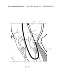 IMPLANT AND METHOD FOR IMPROVING COAPTATION OF AN ATRIOVENTRICULAR VALVE diagram and image