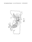 TRACHEAL TUBE AND SUCTION DEVICE diagram and image