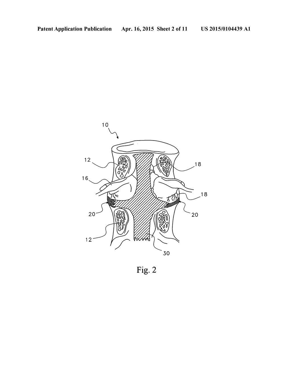 PHARMACEUTICAL REMOVAL OF NEURONAL EXTENSIONS FROM A DEGENERATING DISC - diagram, schematic, and image 03