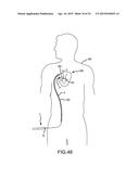 FIVE DEGREE OF FREEDOM ULTRASOUND CATHETER AND CATHETER CONTROL HANDLE diagram and image