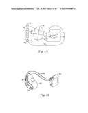 METHOD FOR DISCRIMINATING BETWEEN VENTRICULAR AND SUPRAVENTRICULAR     ARRHYTHMIAS diagram and image