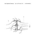 METHOD FOR KNEE RESECTION ALIGNMENT APPROXIMATION IN KNEE REPLACEMENT     PROCEDURES diagram and image