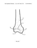 METHOD FOR KNEE RESECTION ALIGNMENT APPROXIMATION IN KNEE REPLACEMENT     PROCEDURES diagram and image