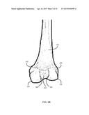 METHOD FOR KNEE RESECTION ALIGNMENT APPROXIMATION IN KNEE REPLACEMENT     PROCEDURES diagram and image