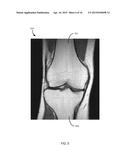 METHOD FOR KNEE RESECTION ALIGNMENT APPROXIMATION IN KNEE REPLACEMENT     PROCEDURES diagram and image