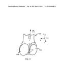 METHOD FOR KNEE RESECTION ALIGNMENT APPROXIMATION IN KNEE REPLACEMENT     PROCEDURES diagram and image