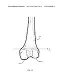 METHOD FOR KNEE RESECTION ALIGNMENT APPROXIMATION IN KNEE REPLACEMENT     PROCEDURES diagram and image