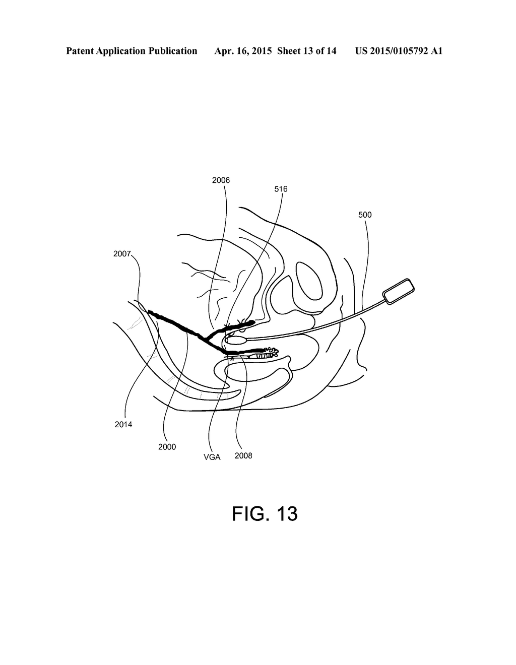 MEDICAL DEVICES AND METHODS FOR MANIPULATING BODILY TISSUES - diagram, schematic, and image 14